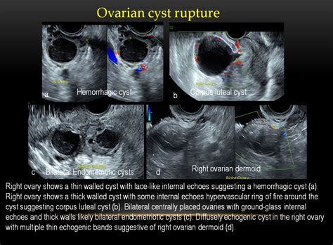 tests done to look for ovarian torsion|twisted or ruptured ovarian cyst.